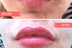 Lips-1