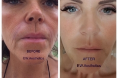Before and after RHA 3 filler