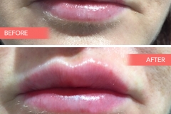 Lips-3