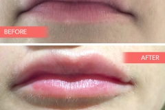 Lips-5
