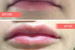 Lips-5
