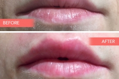 Lips-6